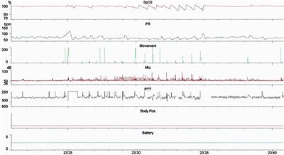 Observational Study of Pulse Transit Time in Children With Sleep Disordered Breathing